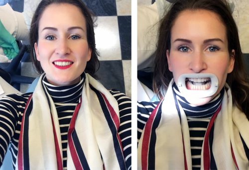 Verzoekschrift Ordelijk helper Witte tanden met Philips Zoom! | Enfait