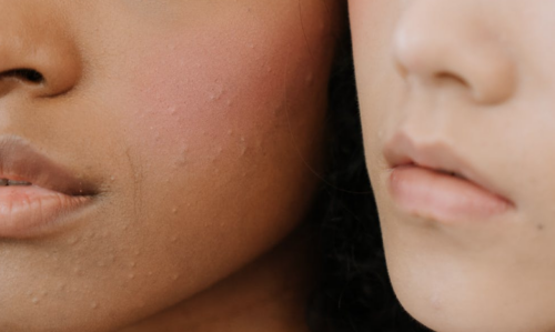 Wordt jouw huid sneller oud in de zomer? The Skin Scan verklap...